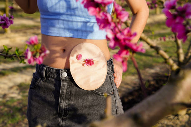 Read more about the article Essential Advice for New Ostomates